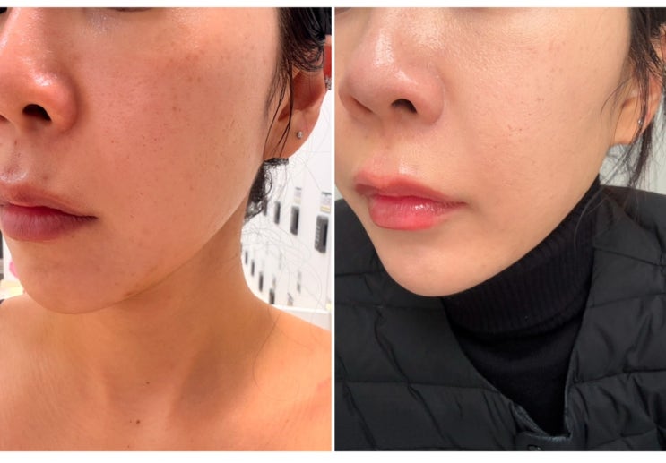  연신내 피부과 꿀광피부 스킨부스터 리쥬란힐러 물광주사 내돈내산 후기