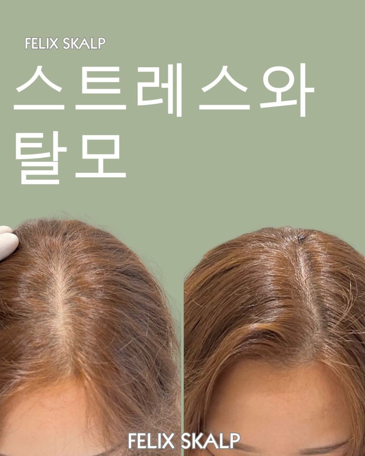  스트레스와 탈모: 연관성과 해결책