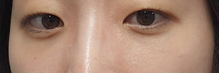  20대 눈밑지방재배치 4개월차 솔직후기