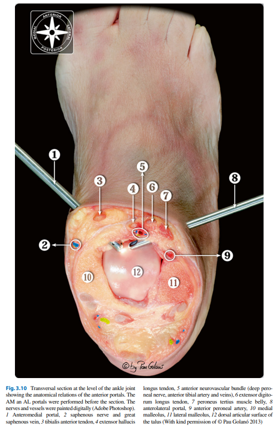 [정형외과 전문의] 발목 관절경 수술의 Basic, synovectomy (Basic of Ankle arthroscope, synovectomy)
