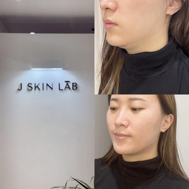  일산피부관리 제이스킨랩 이중턱관리 피부과 대신 선택한 이유