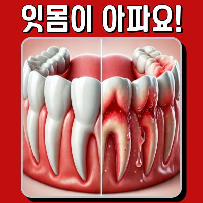 치아는 멀쩡한데 잇몸이 아프다면? 치주 질환 의심!