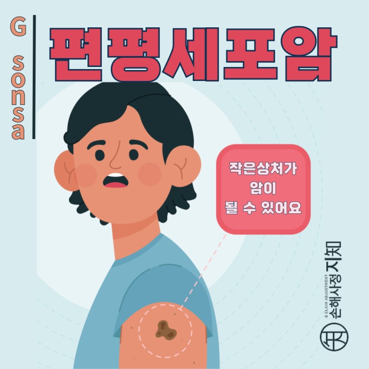  편평세포암 – 작은 상처가 암으로 변할 수 있다! - [피부암, 1부]