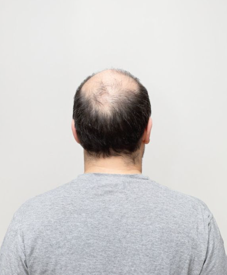  탈모의원인