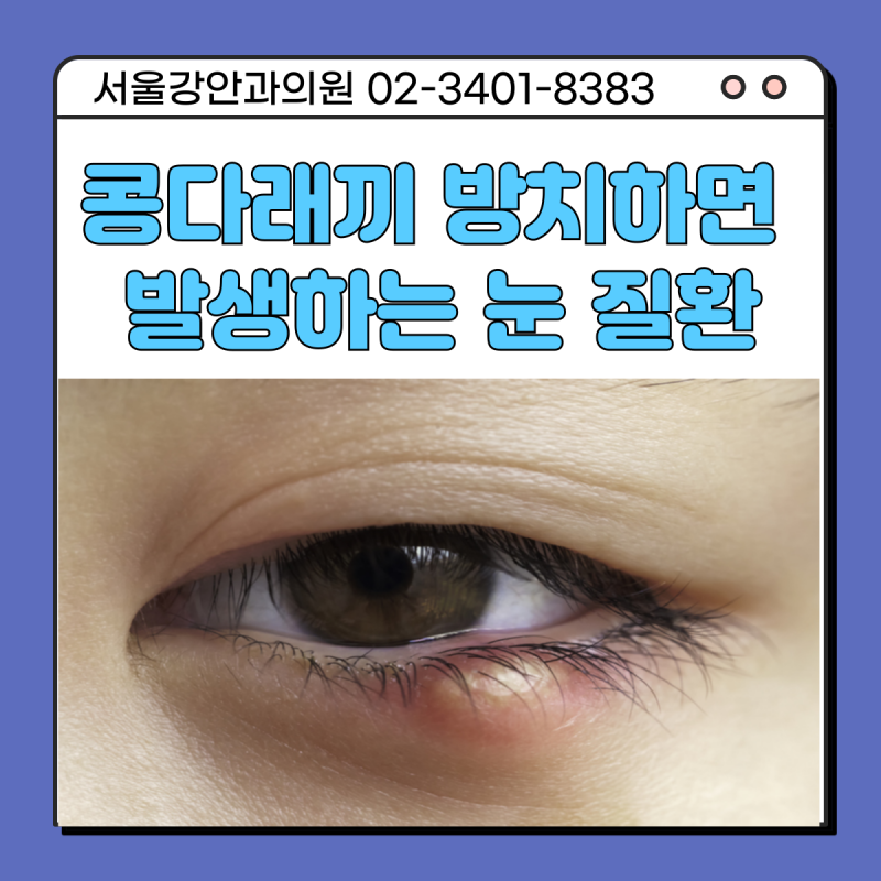 콩다래끼 방치하면 다양한 눈질환으로 이어질 수도