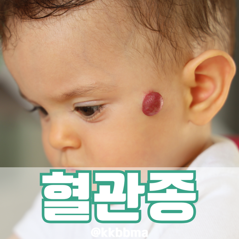혈관종 종류 원인 레이저 주사 VS 영양제 제거 될까?