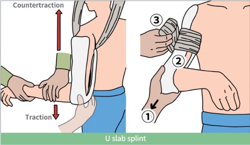 [응급실간호] splint 종류 1편. 상지 splint, armsling 총정리 : 네이버 블로그
