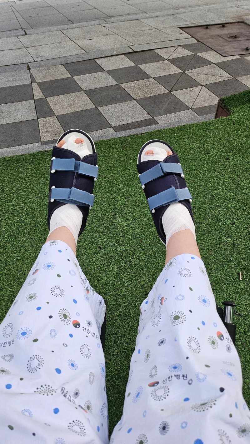 무지외반증 수술후기, 광주 무지외반증 수술, 무지외반증 최소침습, 무지외반증 수술전후, ....