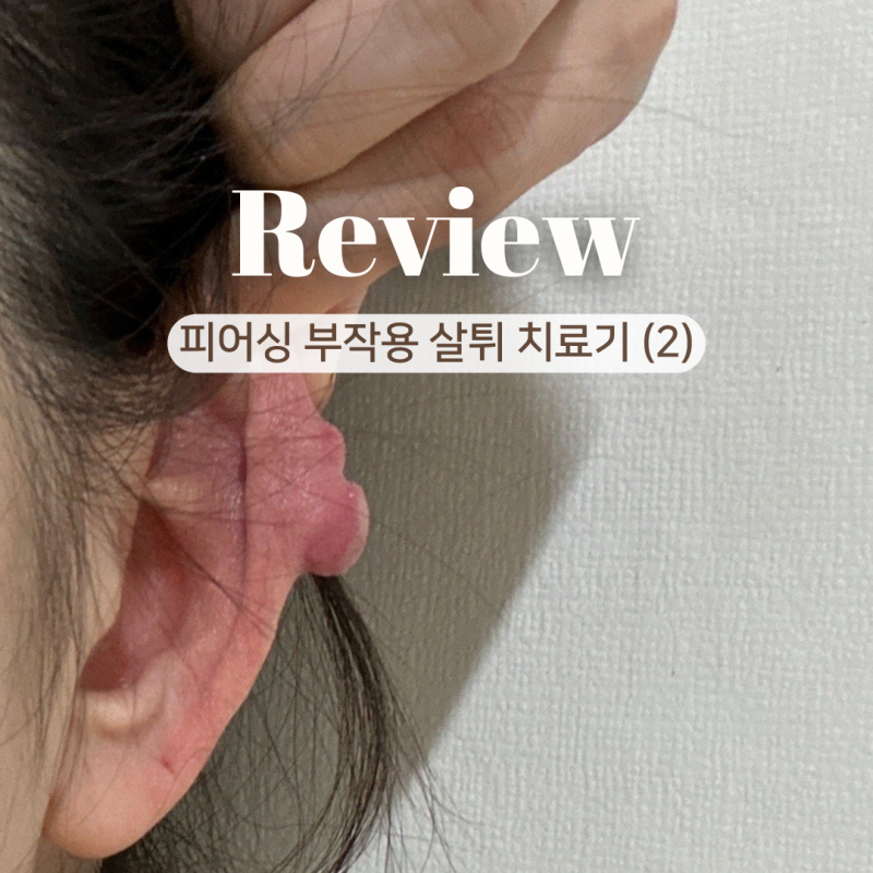피어싱 부작용 살튀 제거 캘로이드 주사 치료기 2편