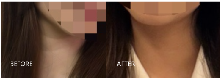  목주름 국산 필러 리쥬비엘 시술 후 변화, 만족도 내돈내산 리얼 후기 (+효과, 부작용, 유지기간)