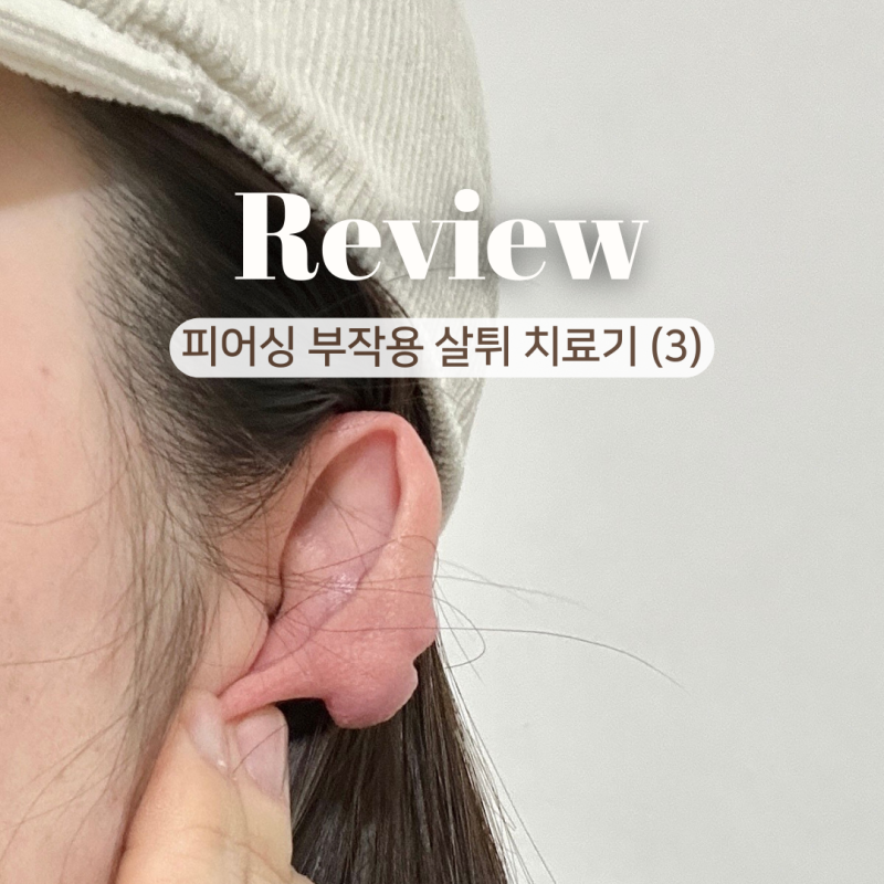 피어싱 부작용 귓바퀴 살튀 제거 캘로이드 피부 주사 치료기 3회차