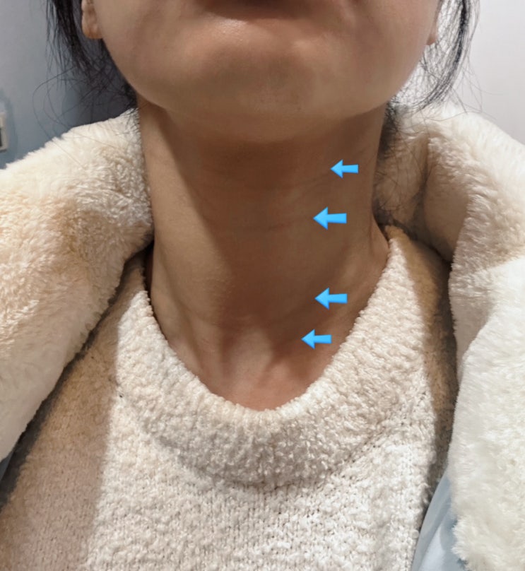  가로 목주름 강남피부과 필러 스킨부스터 비포애프터 만족 후기