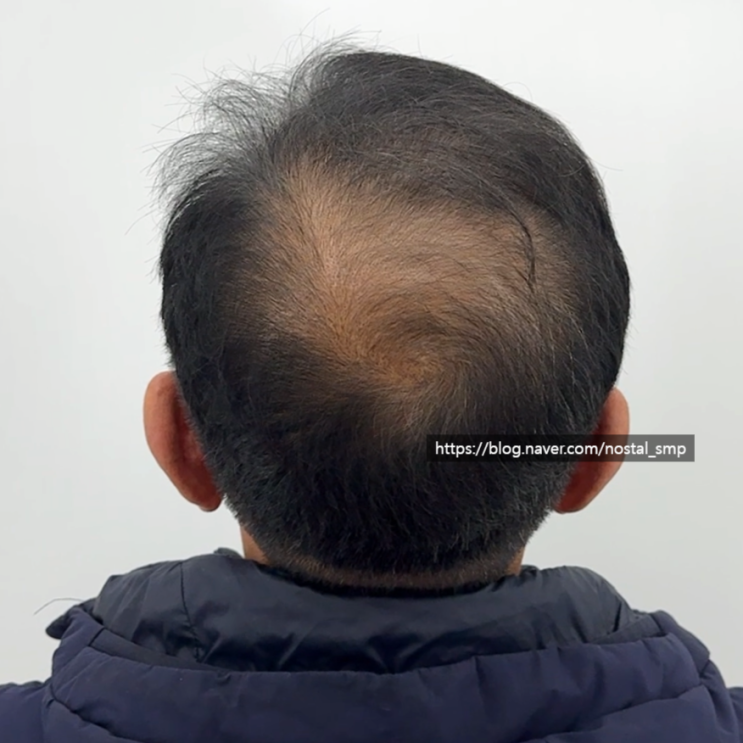  대전두피문신잘하는곳, 탈모 해결하기