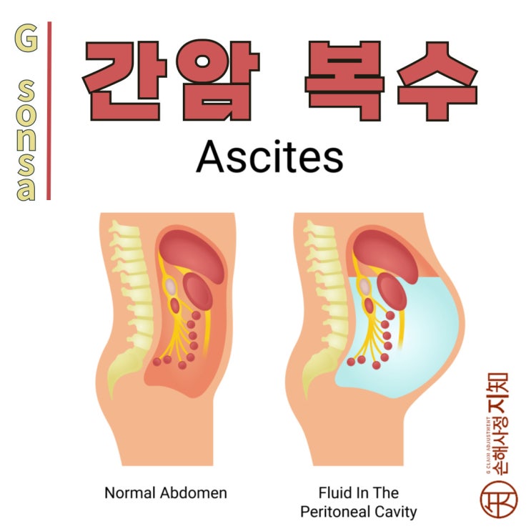  간암 복수 - 물이 새는 수도관처럼, 왜 배에 물이 차오를까? - [간암 정보, 8부]