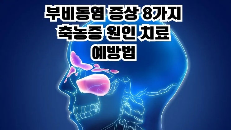  부비동염 증상 8가지 축농증 원인 치료 예방법6