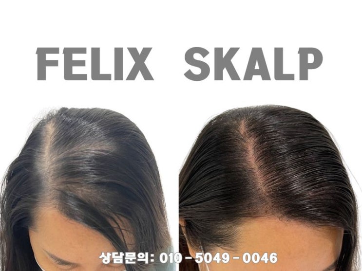  검단두피문신후기: 여성정수리탈모커버 필릭스스칼프에서