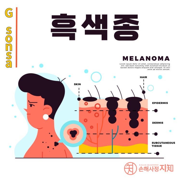  흑색종의 비밀 - 작은 점이 보내는 위험한 경고 - [피부암, 3부]