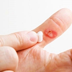 손가락 화상연고 올바르게 사용해서 통증을 잠재우자