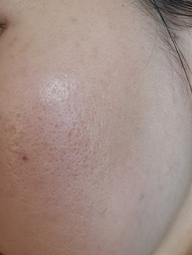 [일상 끄적끄적] 저는 제 피부가 정말 싫(었)어요