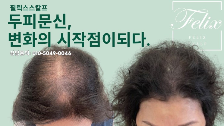  일산두피문신, 시술 전후 비교로 보는 놀라운 변화
