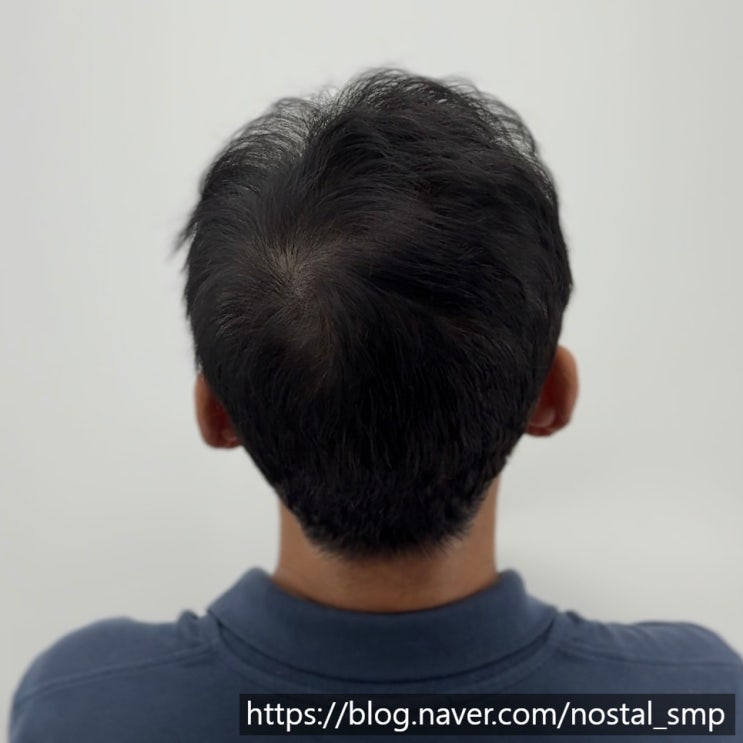  대전두피문신 가격부터 통증까지 궁금증 해결!!