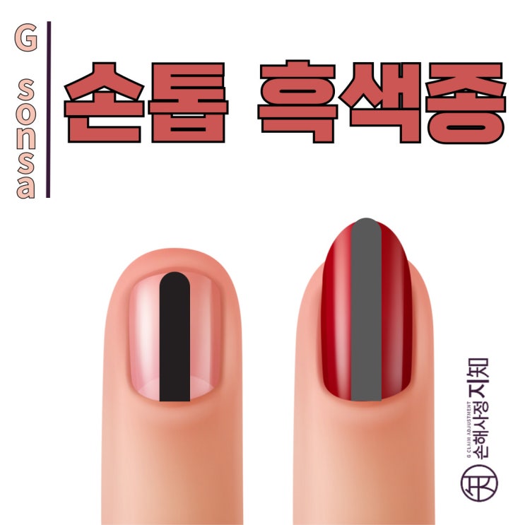  손톱 흑색종, 멍인 줄 알았던 손톱의 검은 줄, 알고보니 암이었다? - [피부암, 5부]