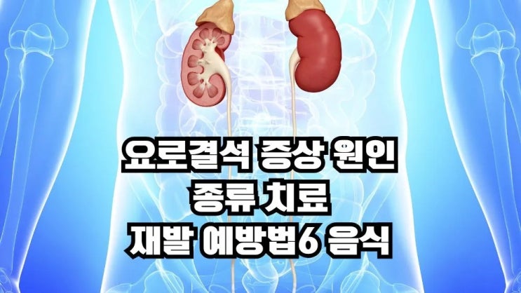  요로결석 증상 원인 종류 치료 재발예방법6 음식