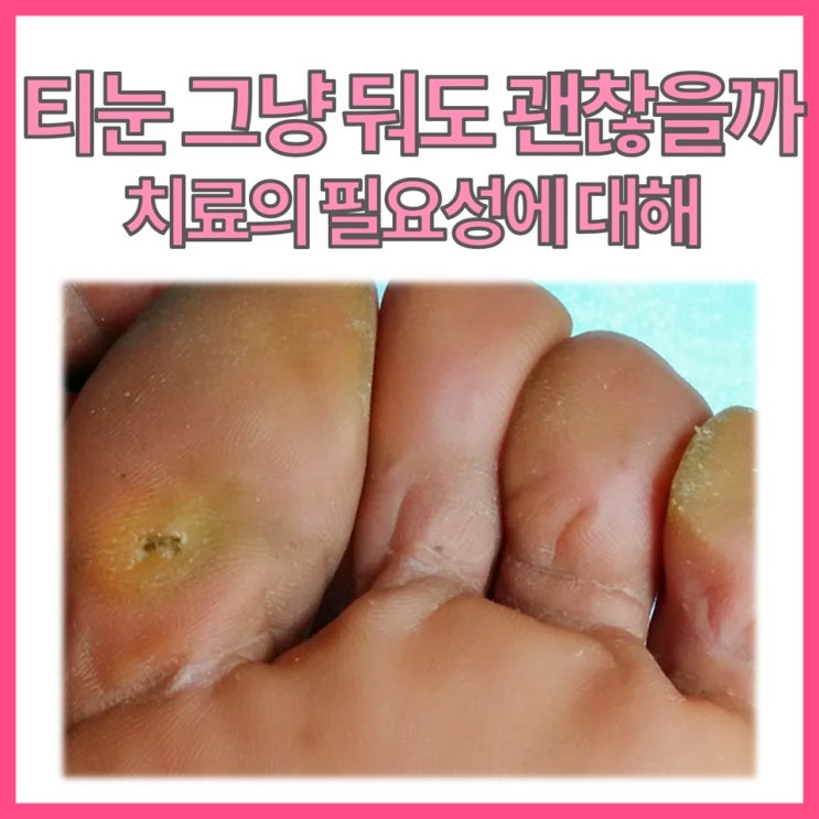  티눈, 그냥 둬도 괜찮을까? 전문의가 말하는 피부과 치료의 필요성!