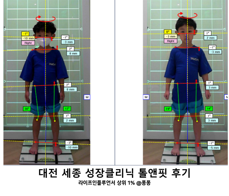  대전 세종 성장클리닉 톨앤핏 체형 분석 관리 교정 후기 키유전 극복 숨은키 찾기