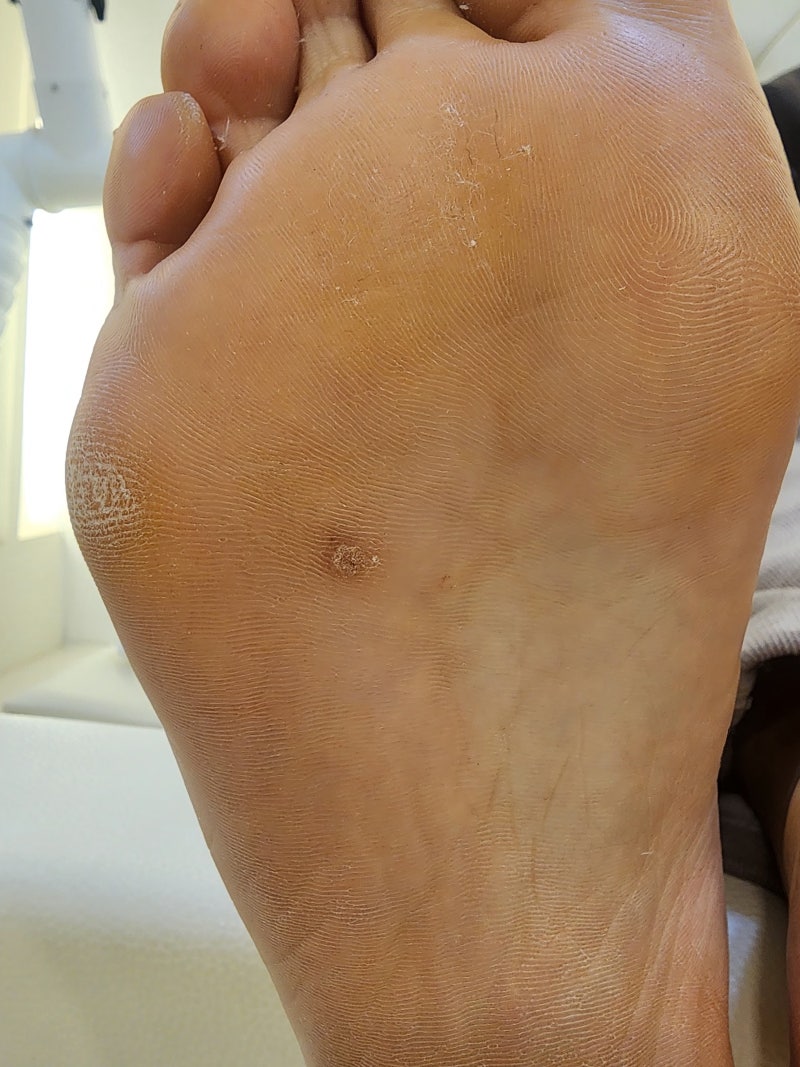 부천 신중동 티눈 제거 티눈관리 각질제거 각질케어 문제성 발 케어 전문 토탈바이오뷰티