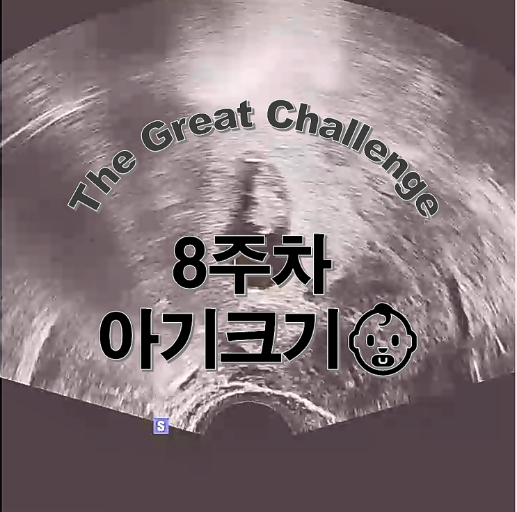  9주차지만 아직 8주차인 아기와 임신초기증상 기록