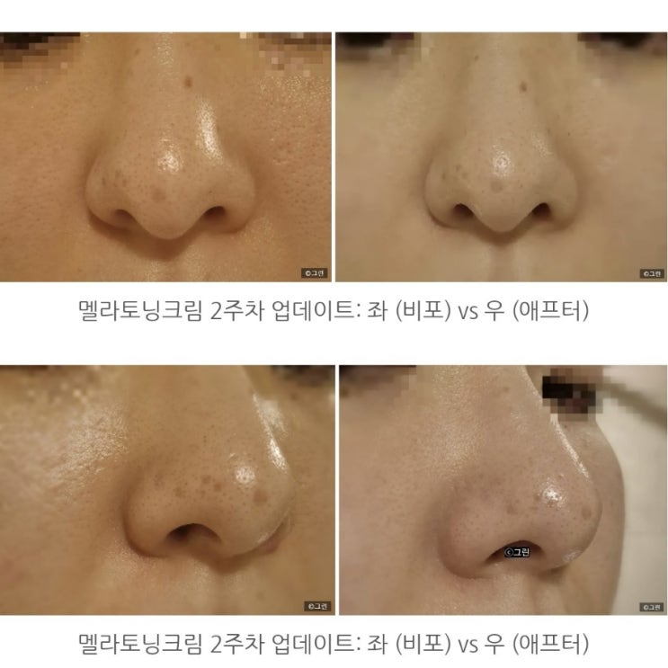  [피부 약국템] 동아제약 히드로퀴논 2% 멜라토닝크림 ️ 2주차 업데이트 (Before & After)