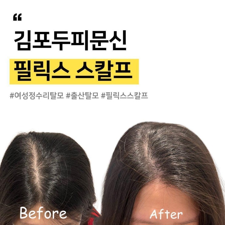  김포두피문신으로 산후탈모 해결!
