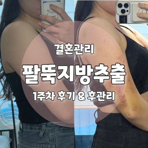  W6. 교대역 팔뚝 지방추출주사 1주차 후기 및 후관리 찐후기