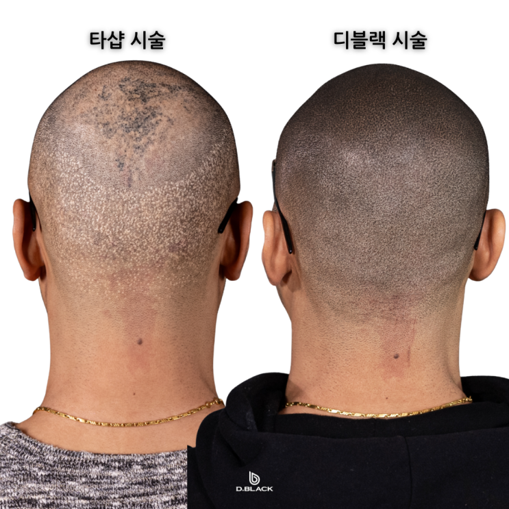  두피문신 창업의 모든 것 A to Z 모두 알려드립니다 <필독>