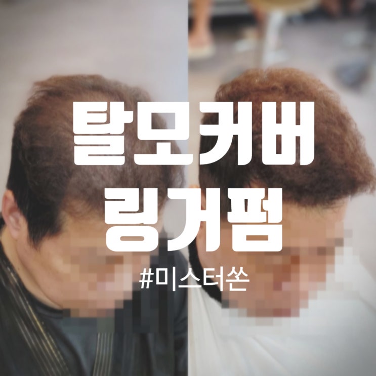  남자 정수리탈모 & M자탈모 커버! 자연스럽게 볼륨 살리는 링거펌