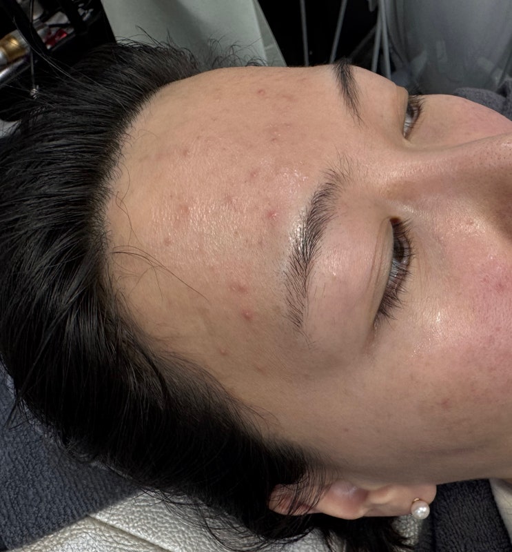 한남동 피부과 여드름 흉터 제거스킨부스터 트리필프로기기 올리디아마요 시술 후기 한남동 피부과 여드름 흉터 제거스킨부스터 트리필프로기기 올리디아마요 시술 후기