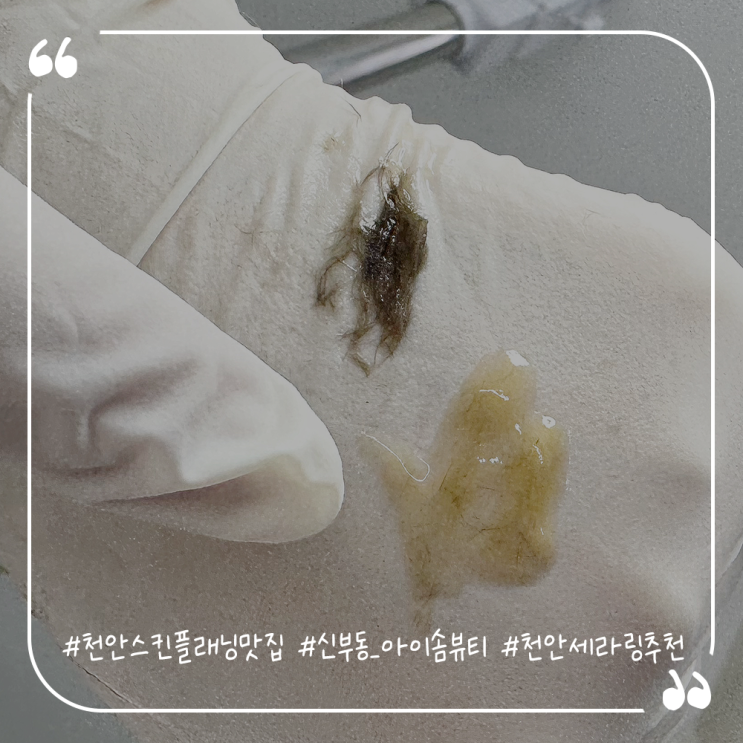  천안스킨플래닝맛집 신부동 아이솜뷰티 천안세라링추천해요