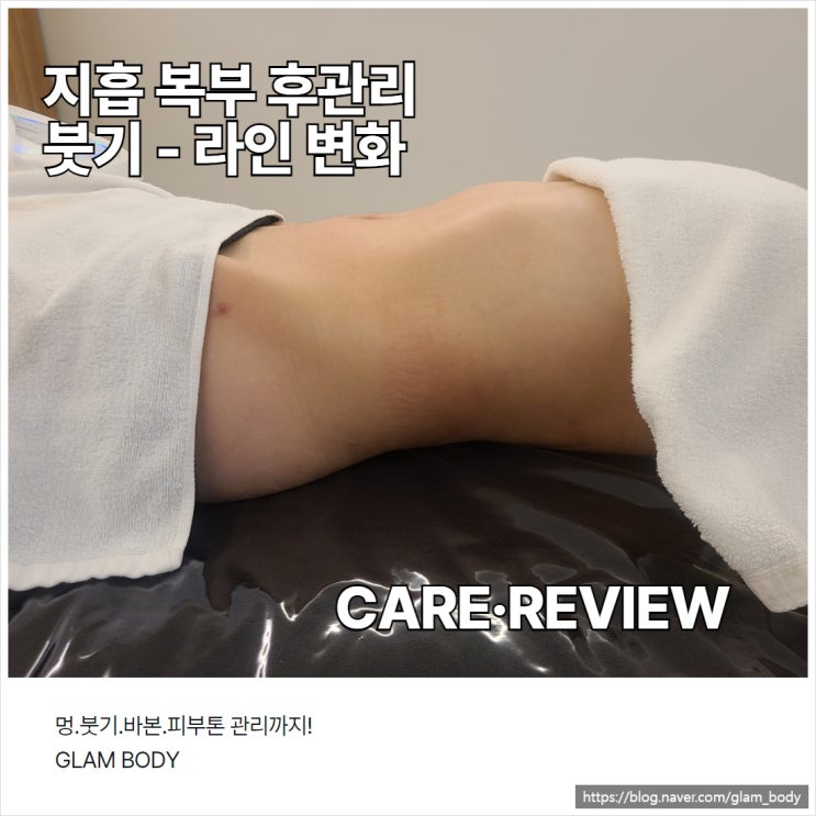  복부 지방흡입 붓기 후관리 사례