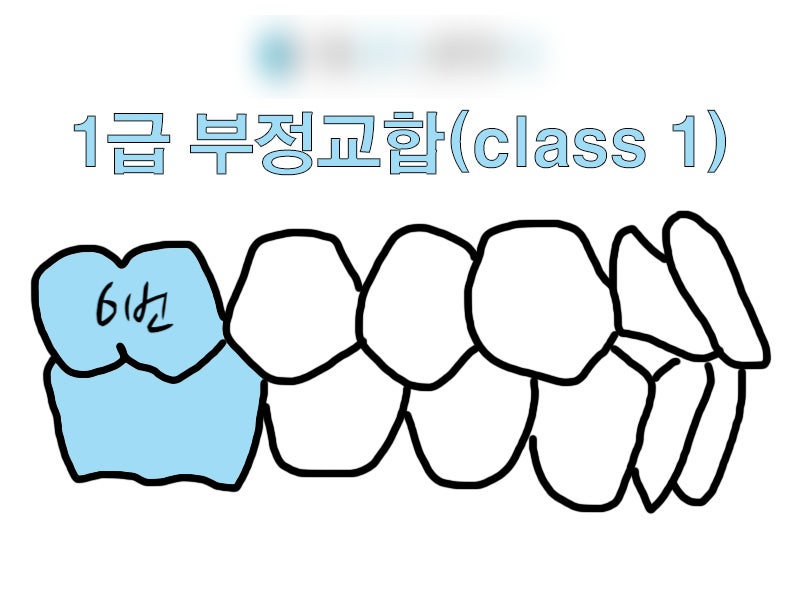 어린이 치아교정 태아보험, 부정교합 도 보장되나요?