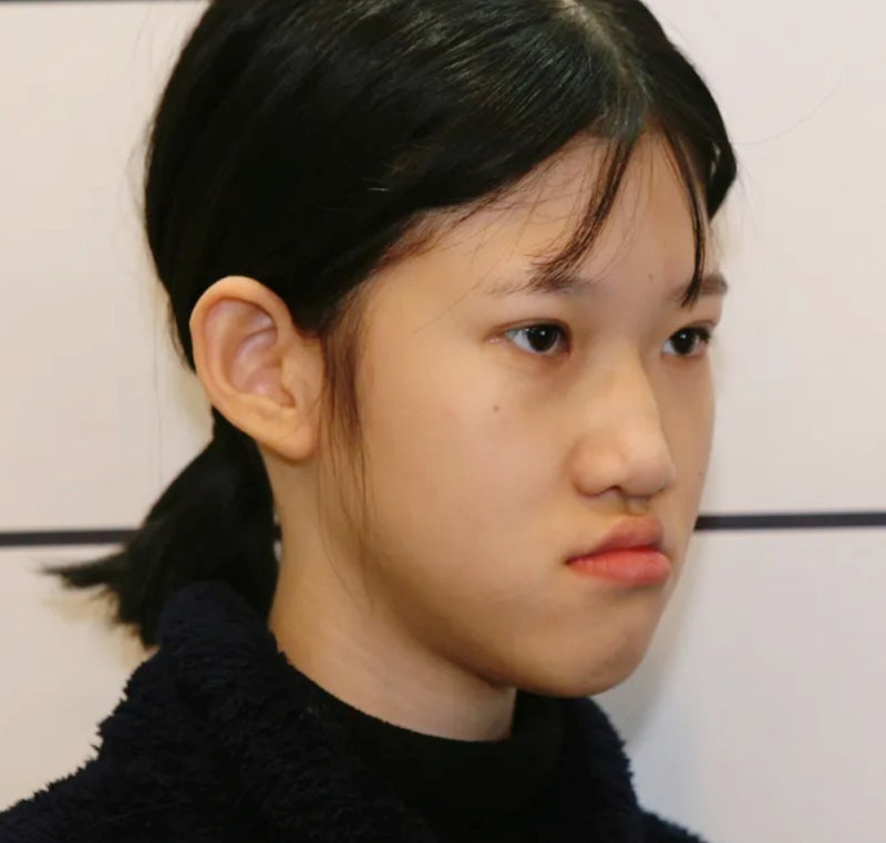 부정교합 교정기 2급, 3급 교정만으로 양악 전후 효과 보기
