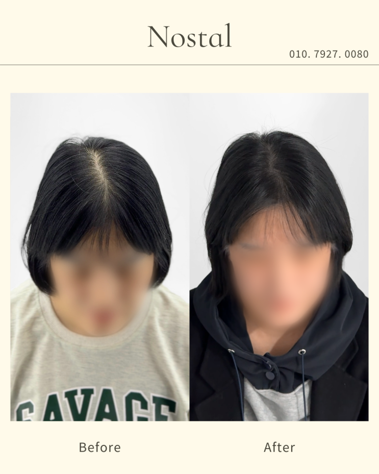  대전정수리두피문신 잘하는 곳, 탈모로 고민하고 계시나요?