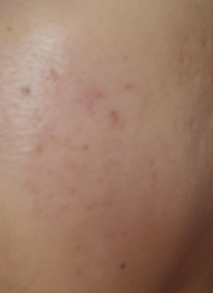  [일산피부과추천]; 여드름, 색소침착, 기미, 주근깨 에 효과적인 피코토닝 레이저 후기 - 1회차
