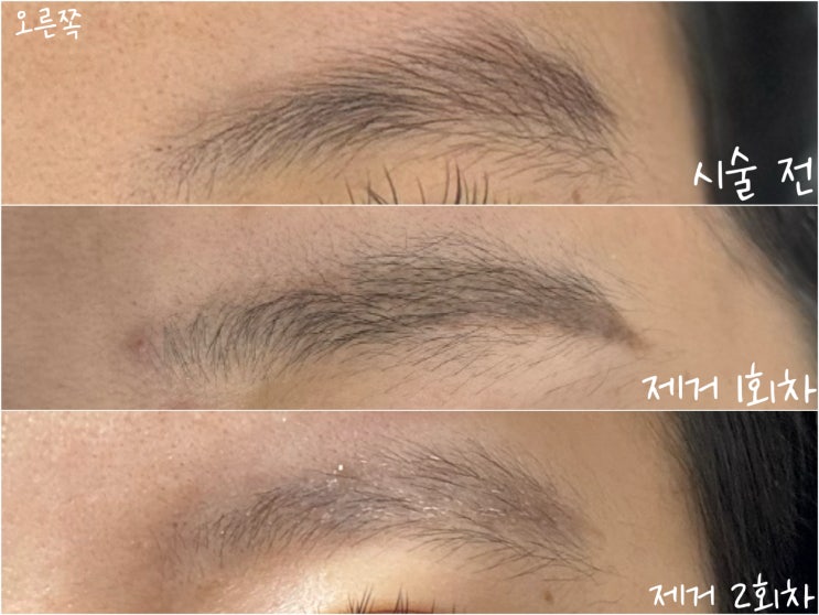  [경상남도 창원시 성산구] 인투미: 눈썹 잔흔 제거