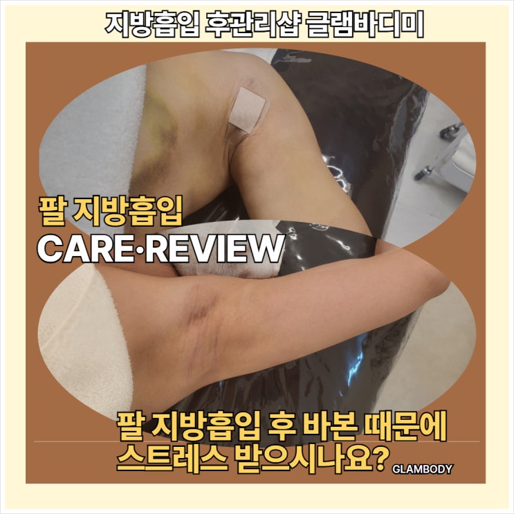  팔 지방흡입 바본 후관리 사례