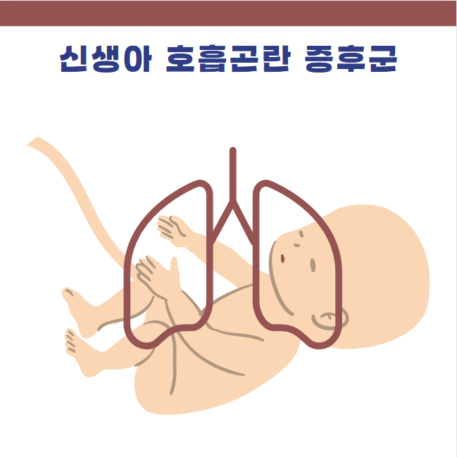 신생아 호흡곤란증후군 원인 증상 치료 폐표면활성제 계면활성제