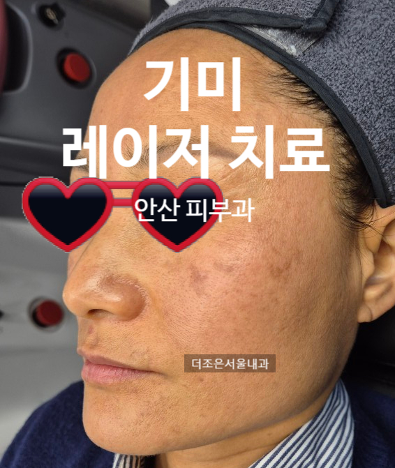  리팟레이저 대신 루비레이저로 40대 기미 흑자 관리 (의사가 작성한 의학지식)