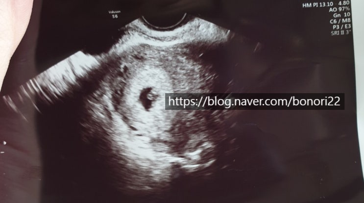  임신 초기 갈색혈 위험할까요? 임테기 확인 후 2주 동안 갈색혈 나와서 내원한 후기 공유해요!(ft.애둘 경산모)