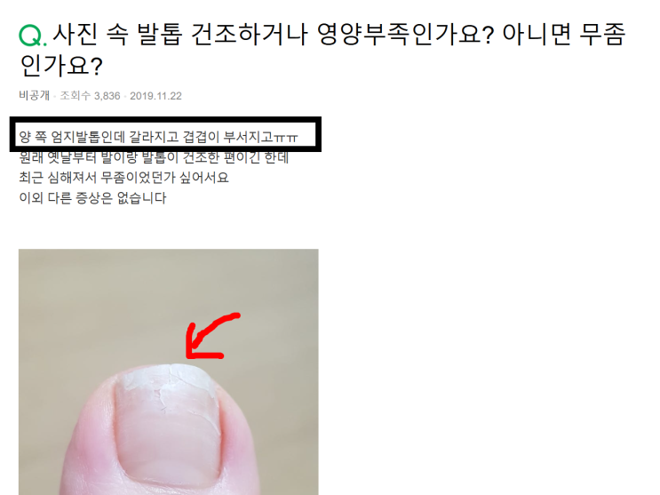  청주 발톱 건강, 물만 마시면 될까?