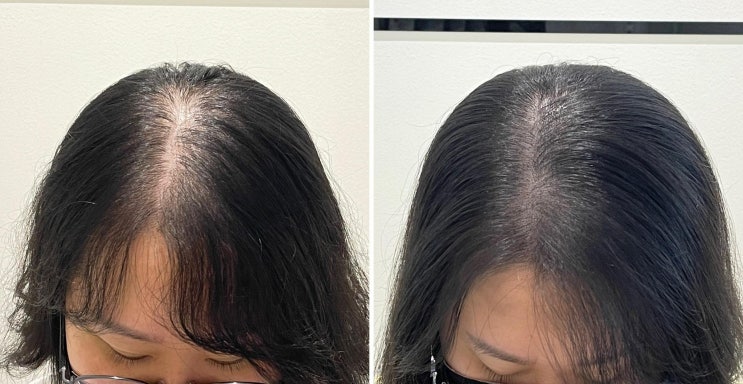  풍무동두피문신리뷰ㅡ집나간 머리카락이 돌아왔다!